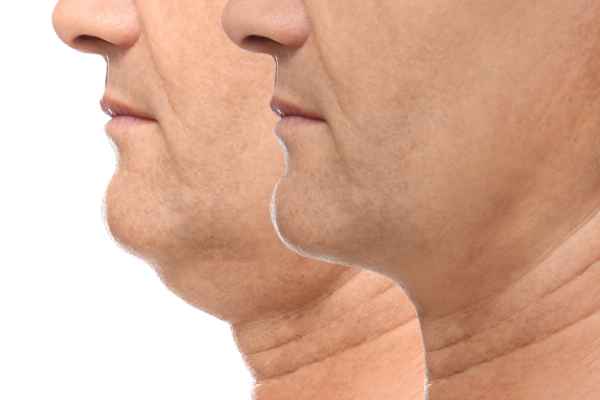 HIFU - Breakthrough in Anti - ageing 2 hifu results Brentford