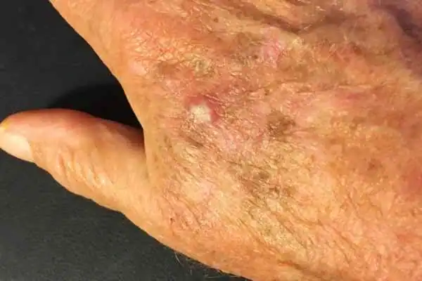 Image of Actinic keratoses Brentford on a person hand