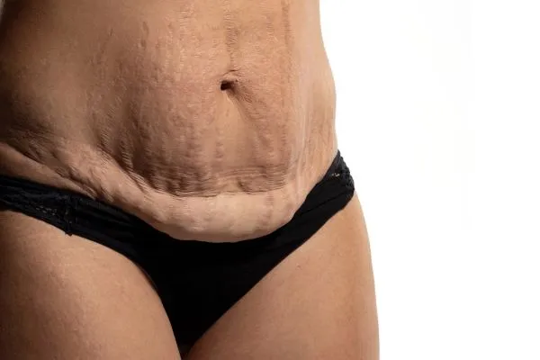 The Science of Skin Tightening 1 The science behind skin tightening Brentford picture of a woman's sagging skin on the stomach